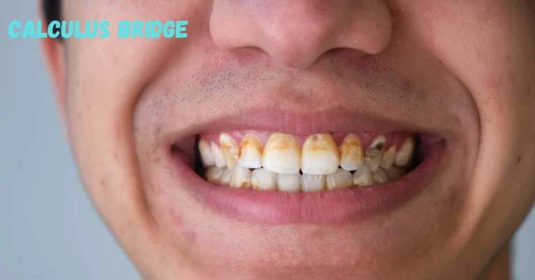 Calculus Bridge: A Deep Dive into Dental Plaque and Tartar Buildup